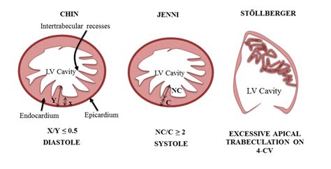 lv non compaction echo criteria